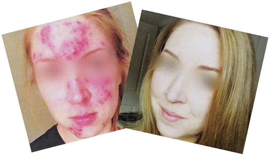 Acne Before & After dermaviduals