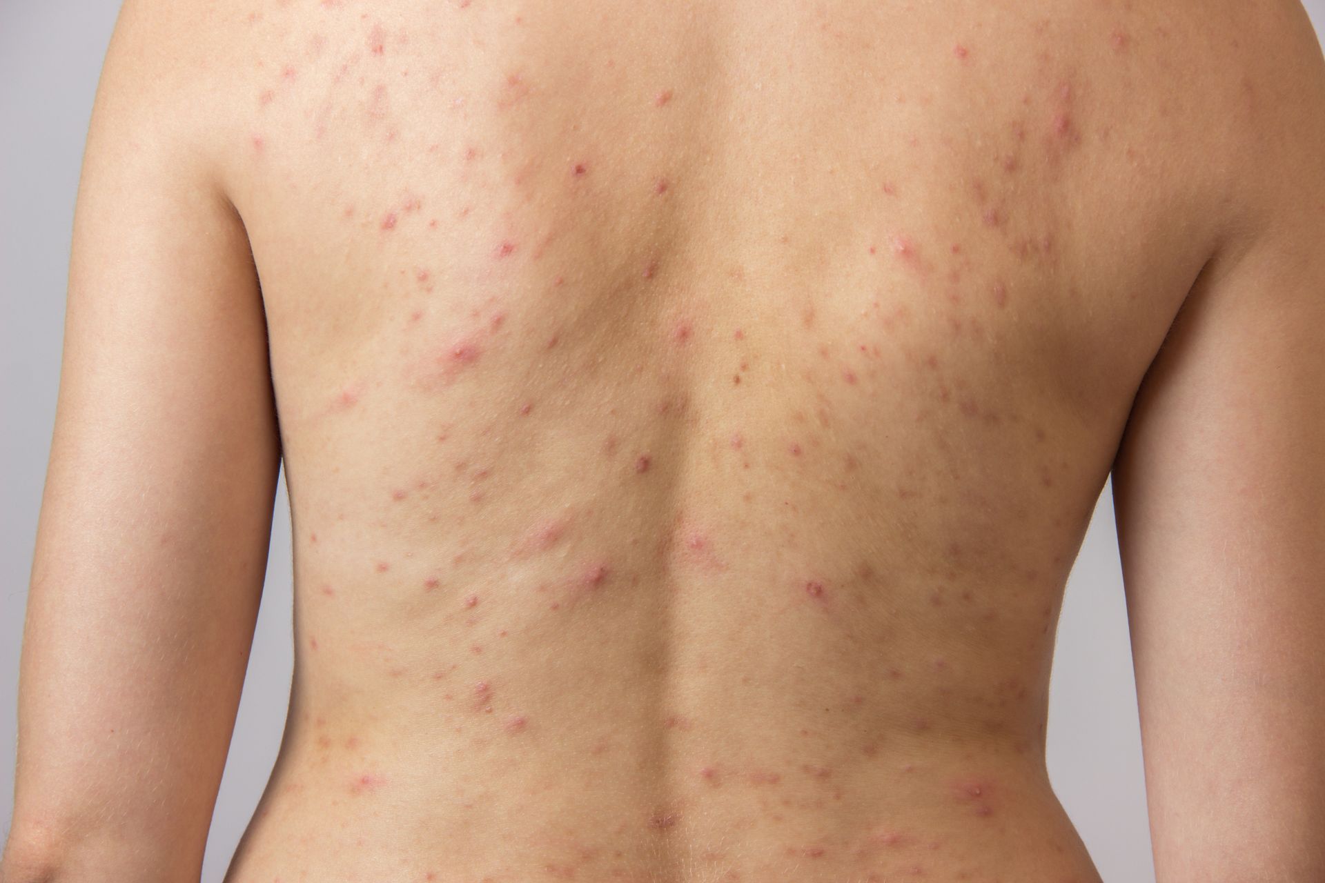 Back Acne