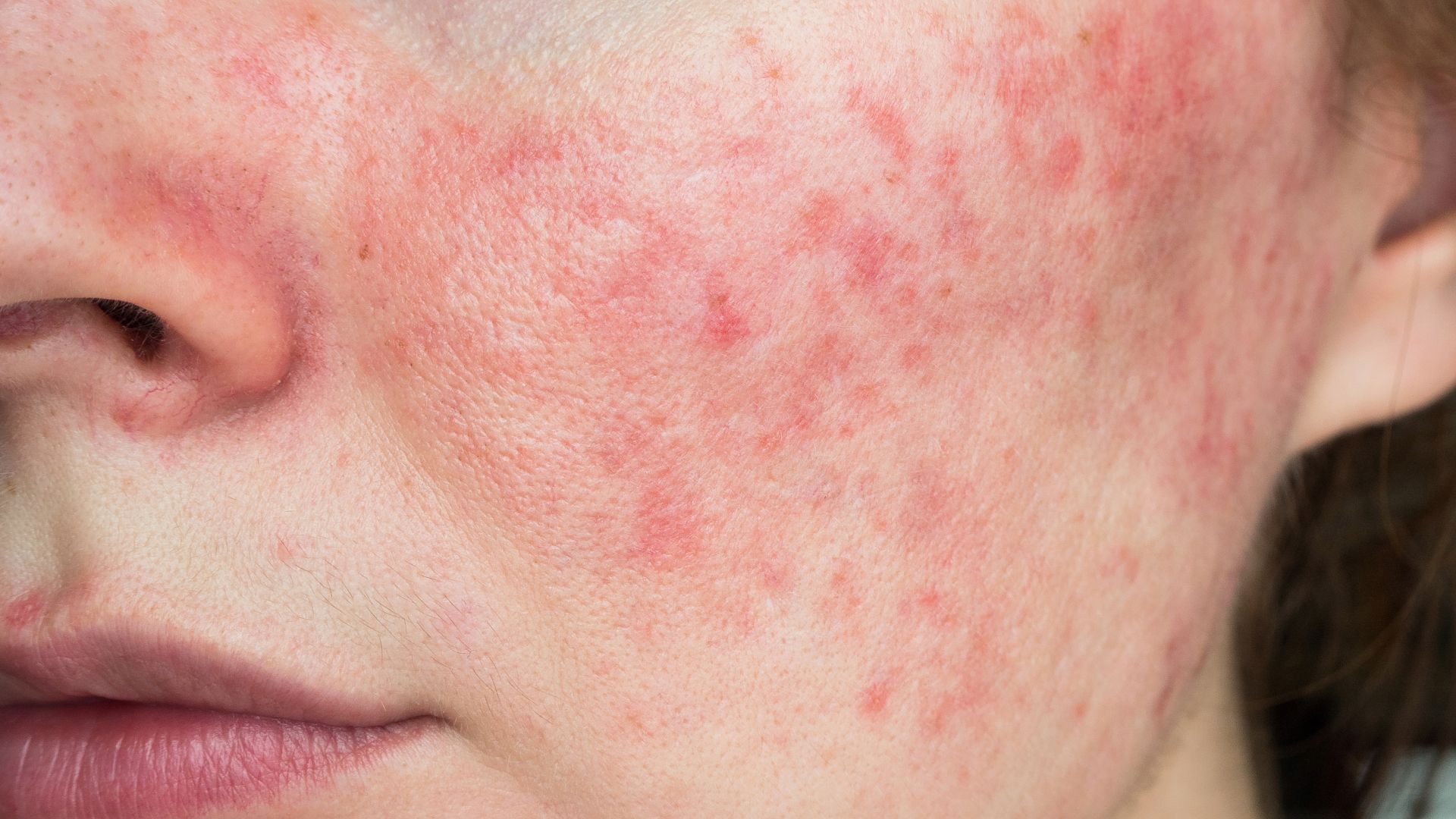 Rosacea on Face